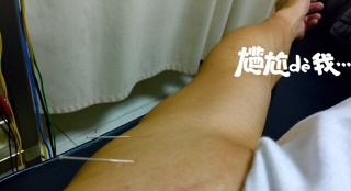 汪東城針灸惹粉絲心疼 自我調(diào)侃：打開任督二脈