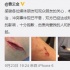 曹云金晒受伤照 承认打群架斗殴：双方已经和解