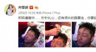 扎心了!鄒市明針灸治療眼疾 左眼十根銀針惹心疼