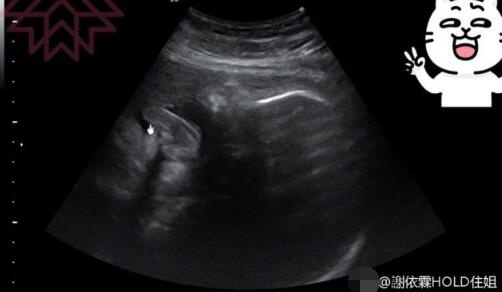 谢依霖孕后首晒宝宝B超照 吐舌造型遭亲妈调侃