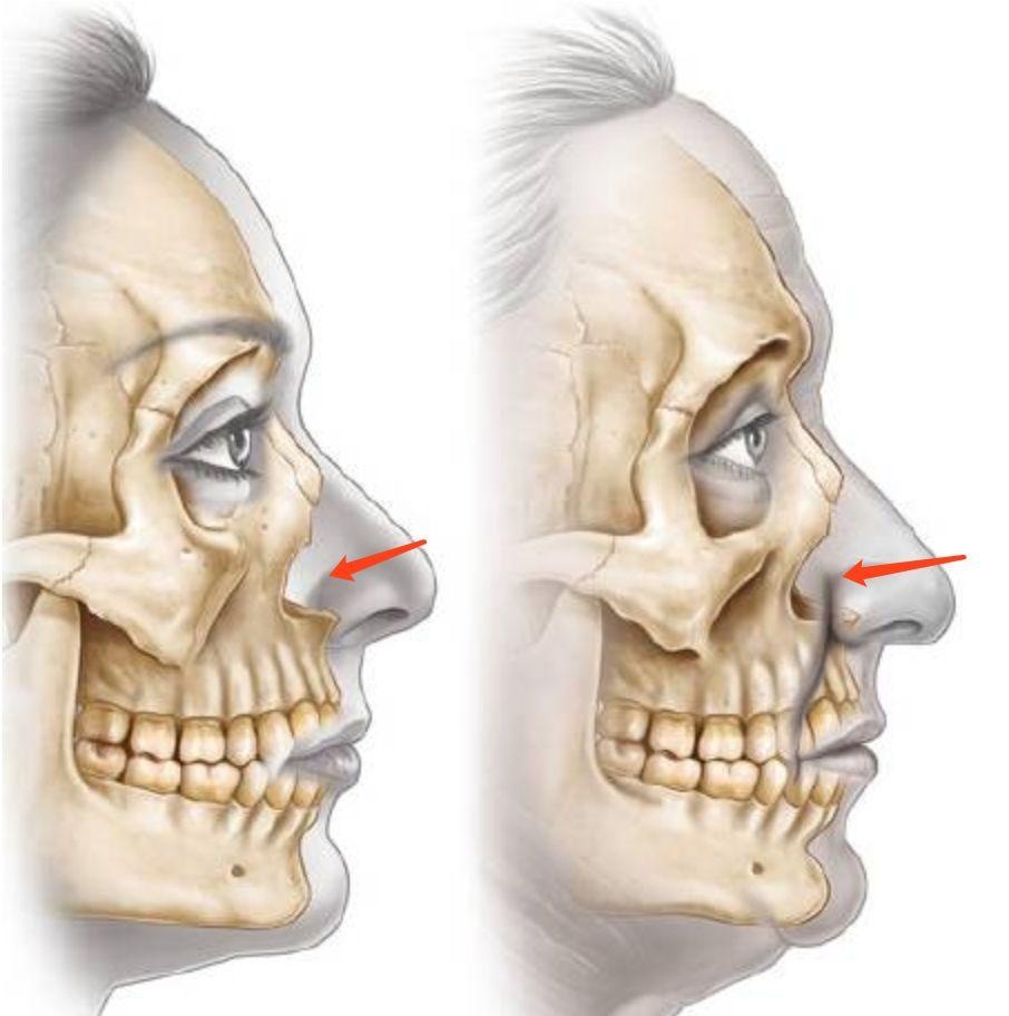 梨状孔也会变大,对鼻尖和鼻翼的支撑力会逐渐减弱.