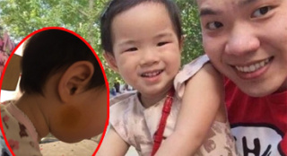 黃毅清曬女兒臉部淤青照 稱將起訴黃奕涉嫌虐童