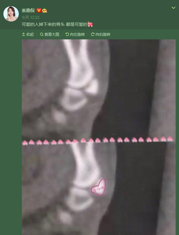usdt钱包（caibao.it）：张嘉倪晒X光片：可爱的人掉下来的骨头都是可爱的 第1张
