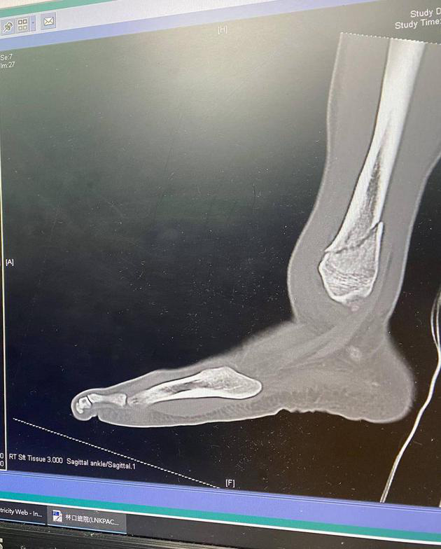 X光片中清楚顯示右腳腳踝骨折